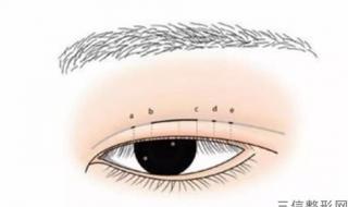 割双眼皮哪家医院好