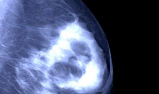 乳腺癌晚期能活多久
